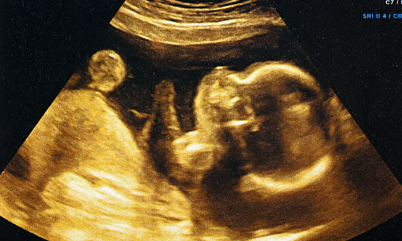 Don de sperme, mère porteuse, droit à l’enfant et droit du co-géniteur: autant de questions qui font débat IStock